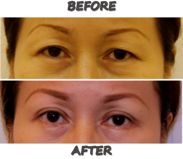 Eyelid Surgery Before and After Images Philippines